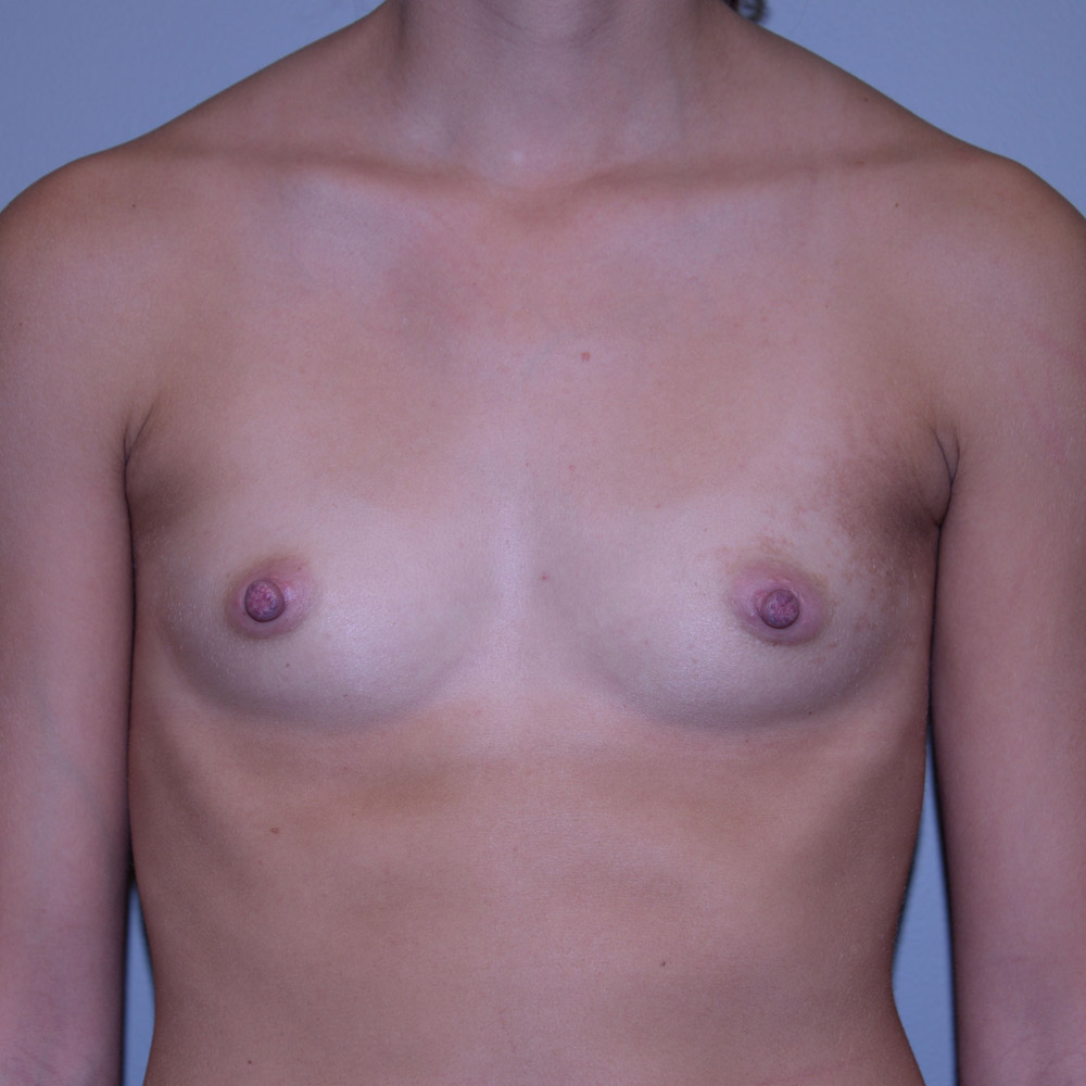 Case--2043 | Before Breast