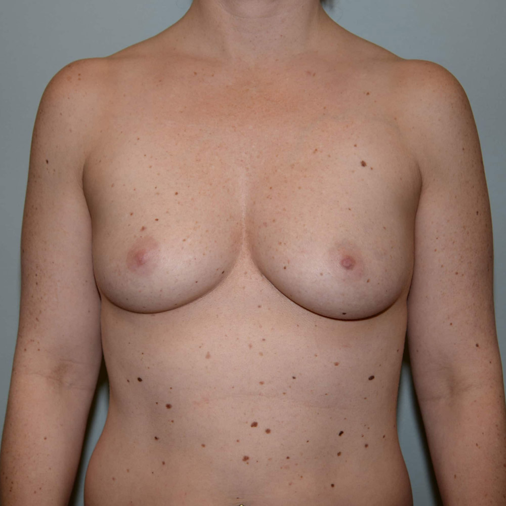 Case--2079 | Before Breast