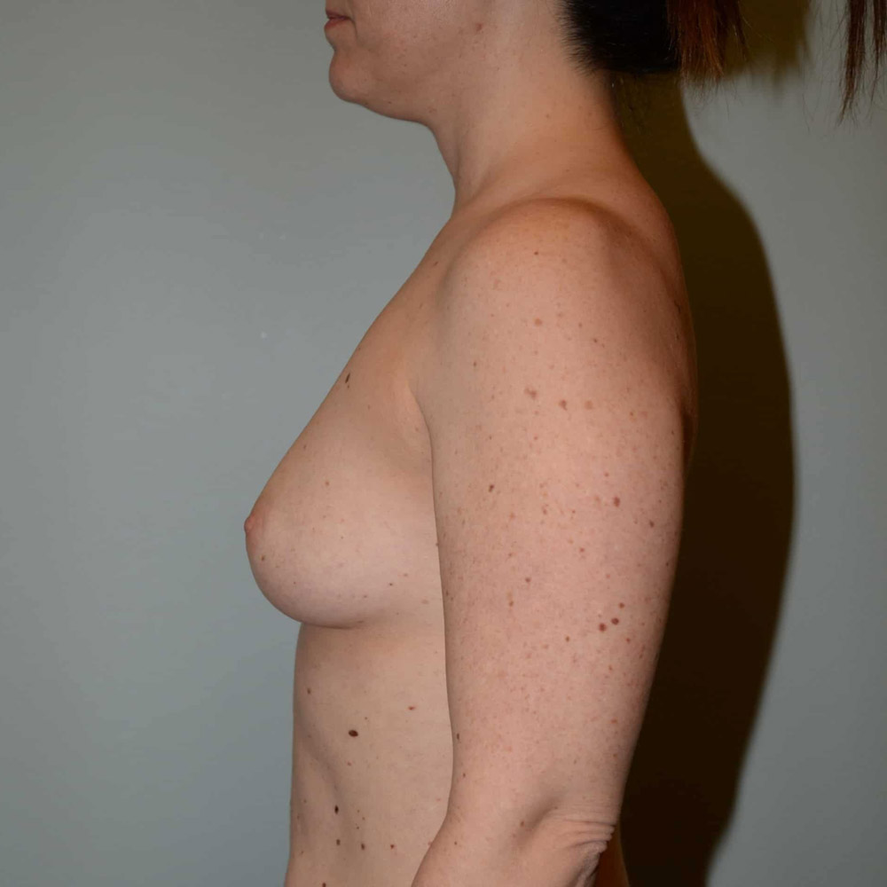 Case--2079 | Before Breast Augmentation 2