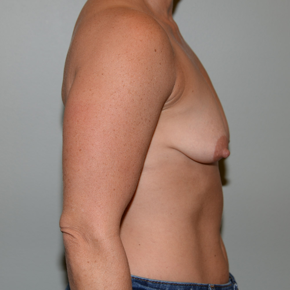 Case--2044 | Before Breast Augmentation 3