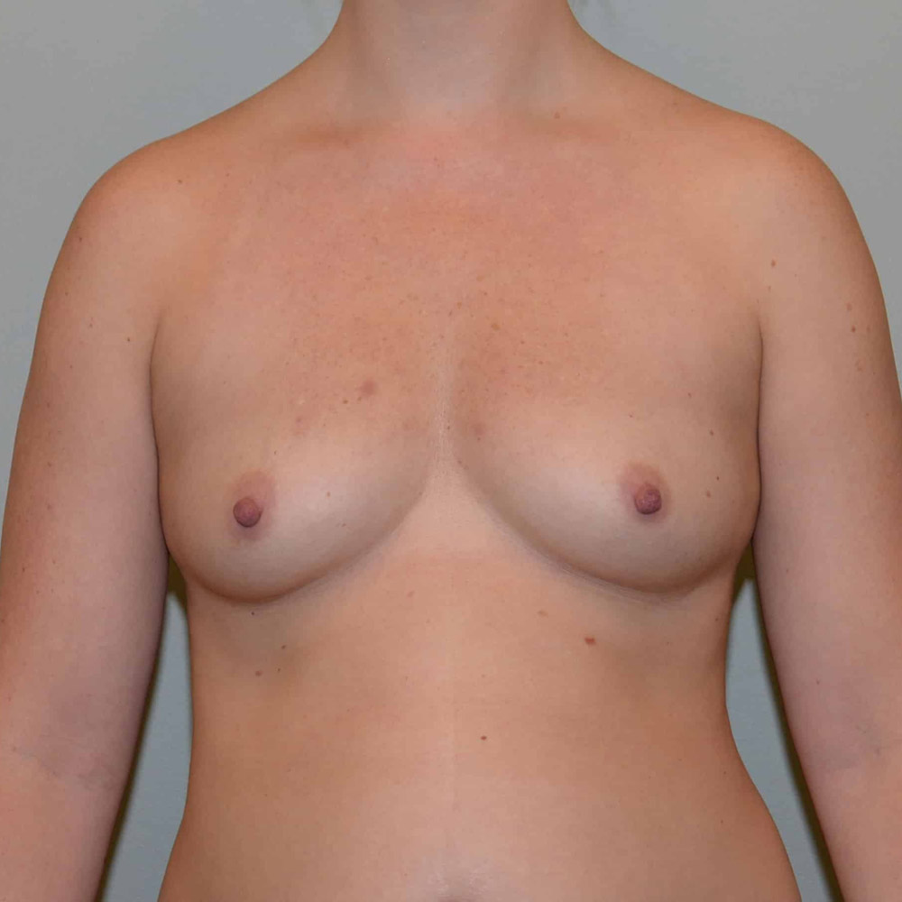 Case--2082 | Before Breast