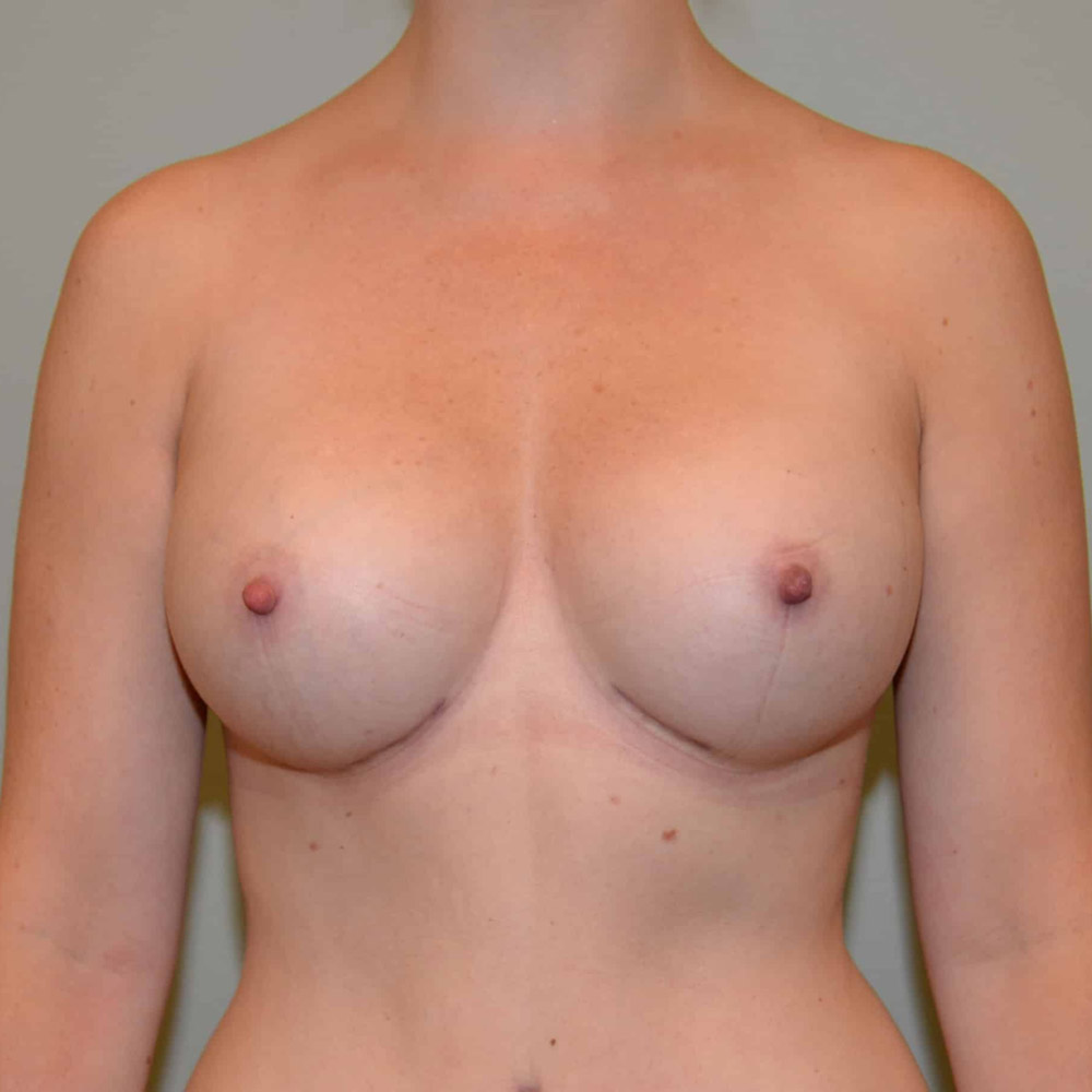 Case--2082 | After Breast