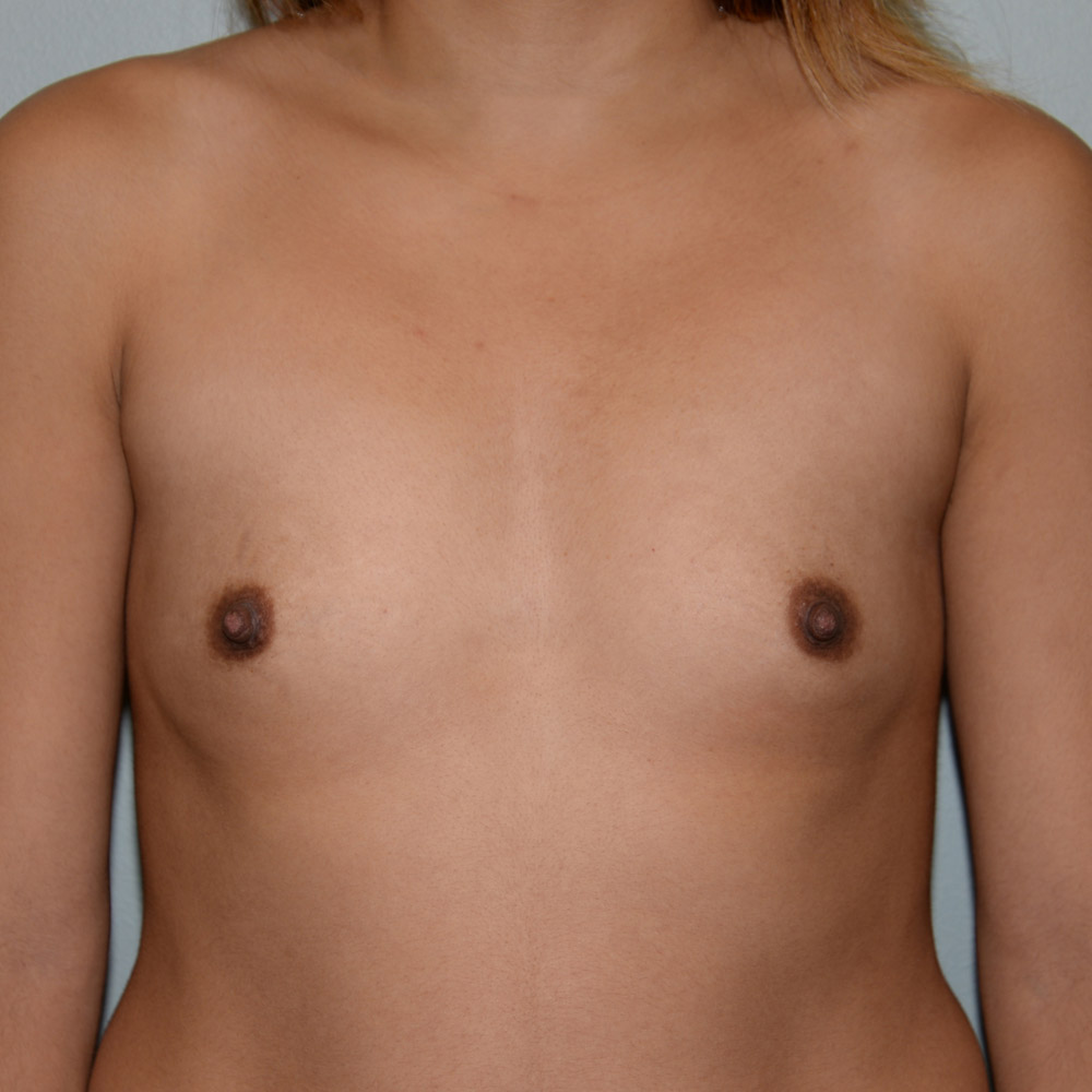 Case--2046 | Before Breast