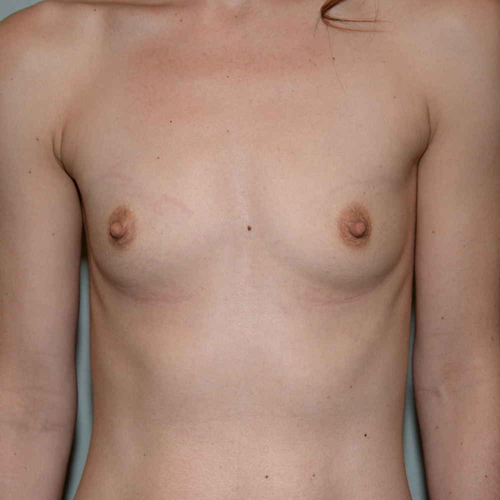 Case--2051 | Before Breast