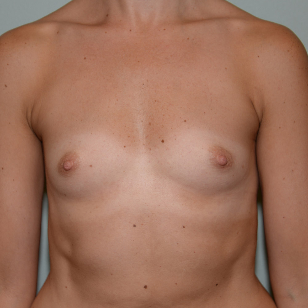 Case--2054 | Before Breast