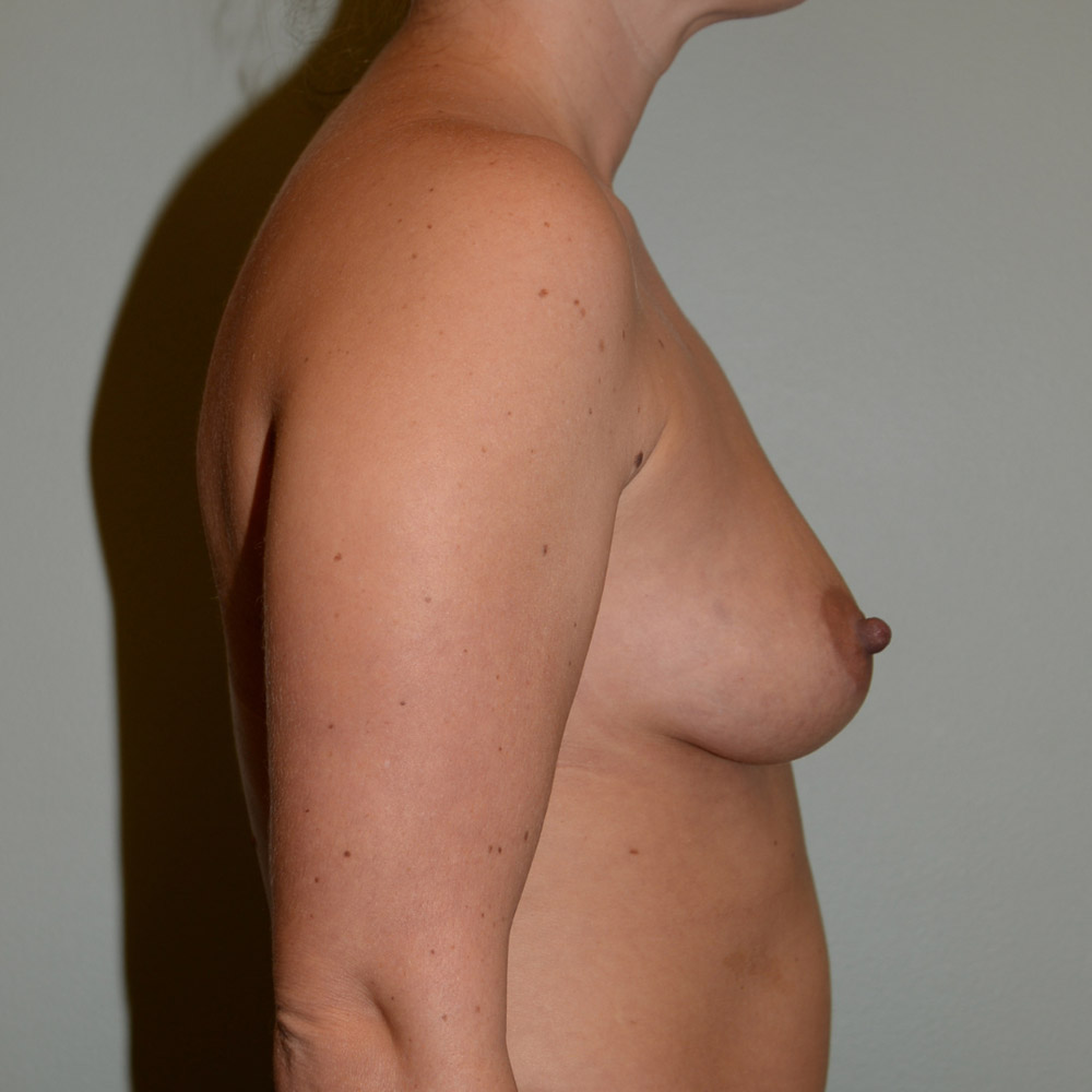 Case--2059 | Before Breast Augmentation 3