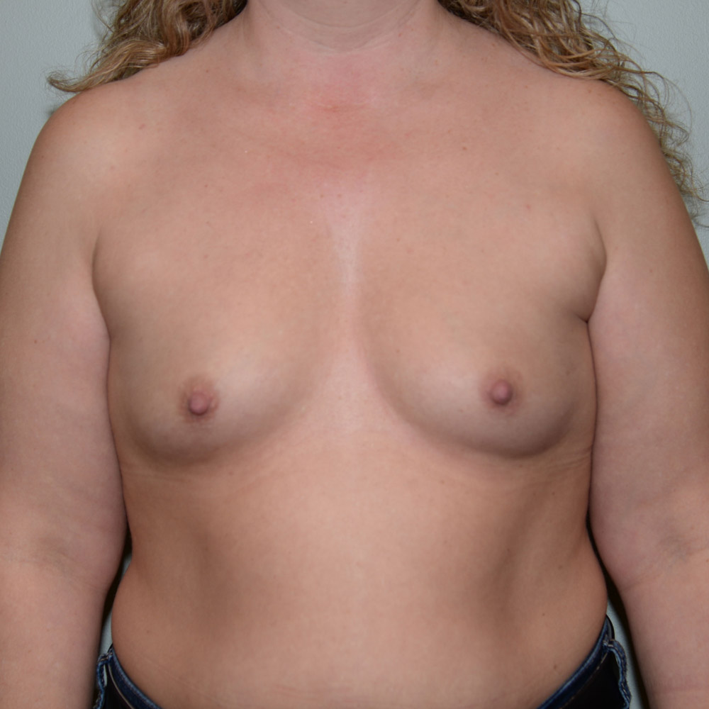 Case--2060 | Before Breast