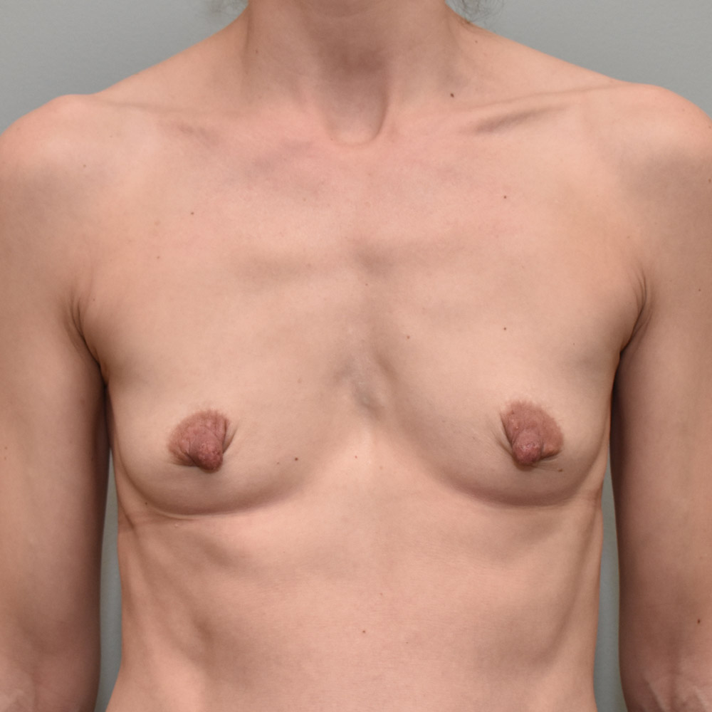 Case--2062 | Before Breast