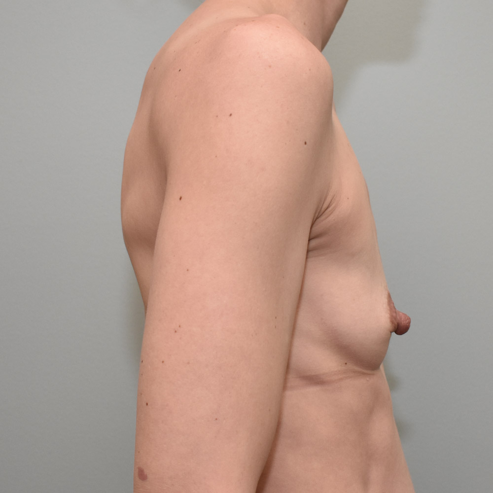 Case--2062 | Before Breast Augmentation 3