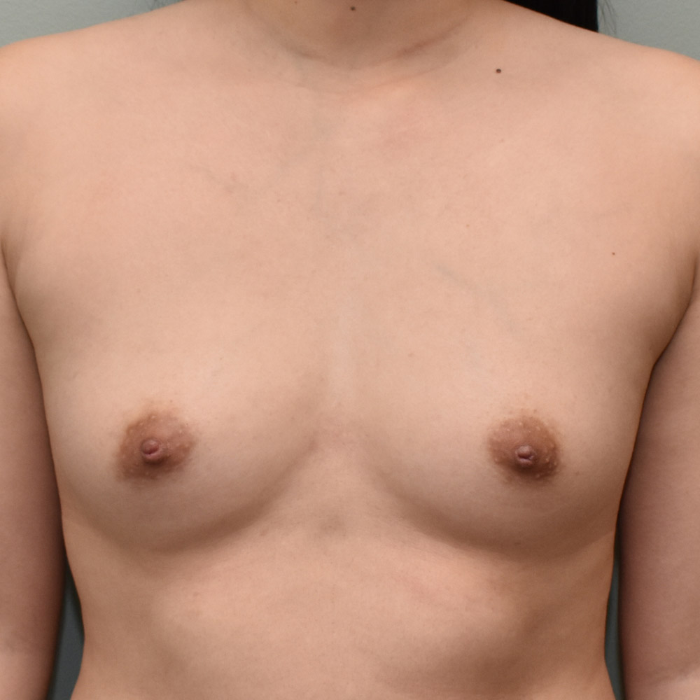 Case--2063 | Before Breast