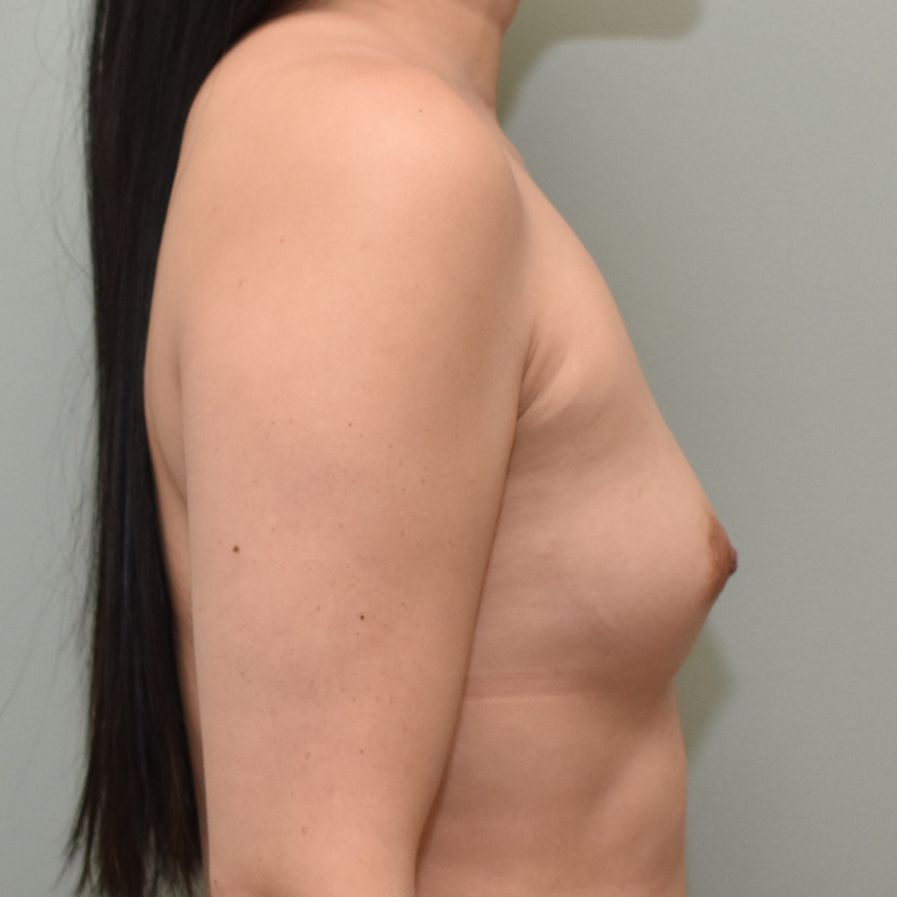 Case--2063 | Before Breast Augmentation 3