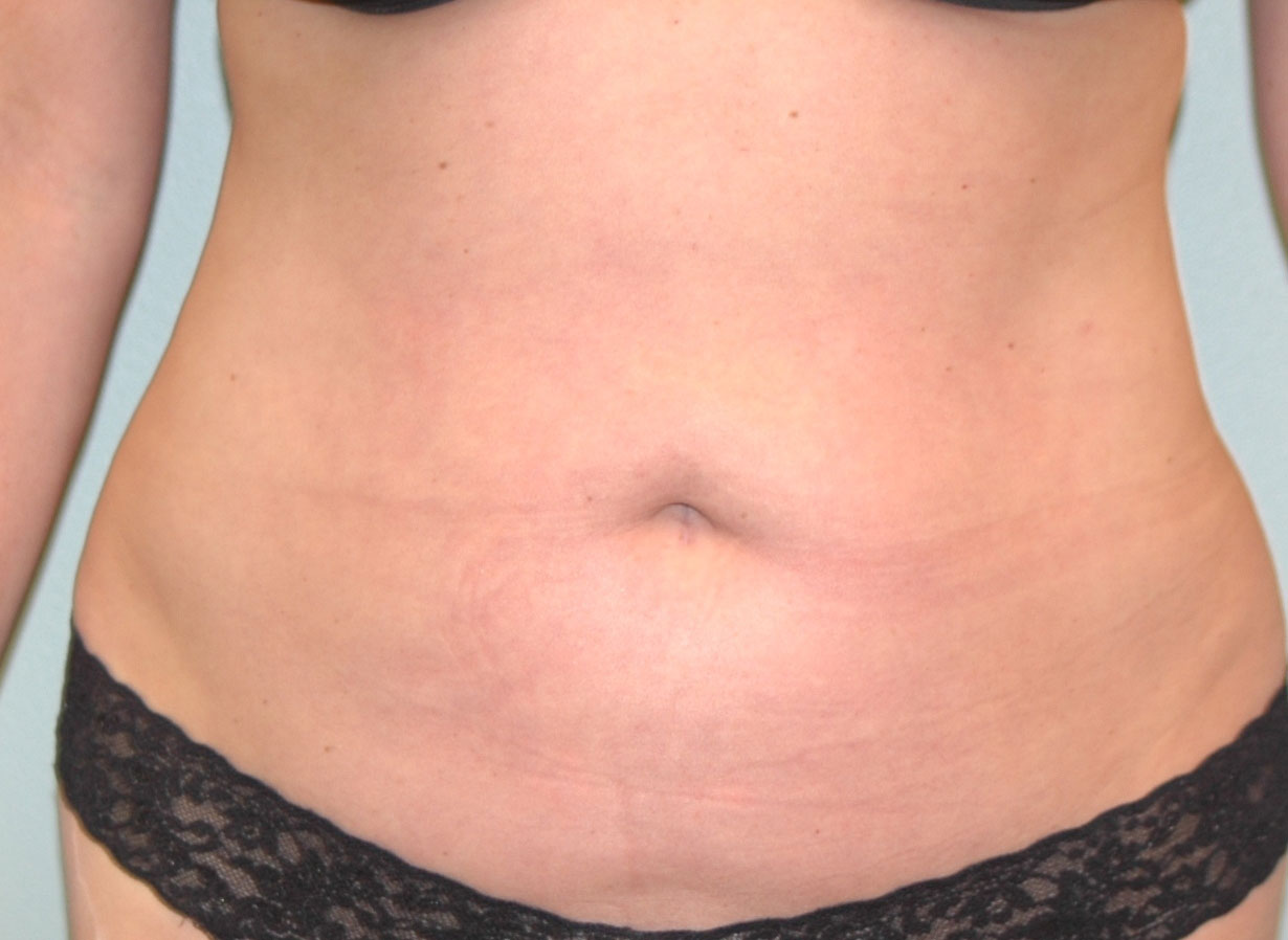 Case--9333 | After Liposuction