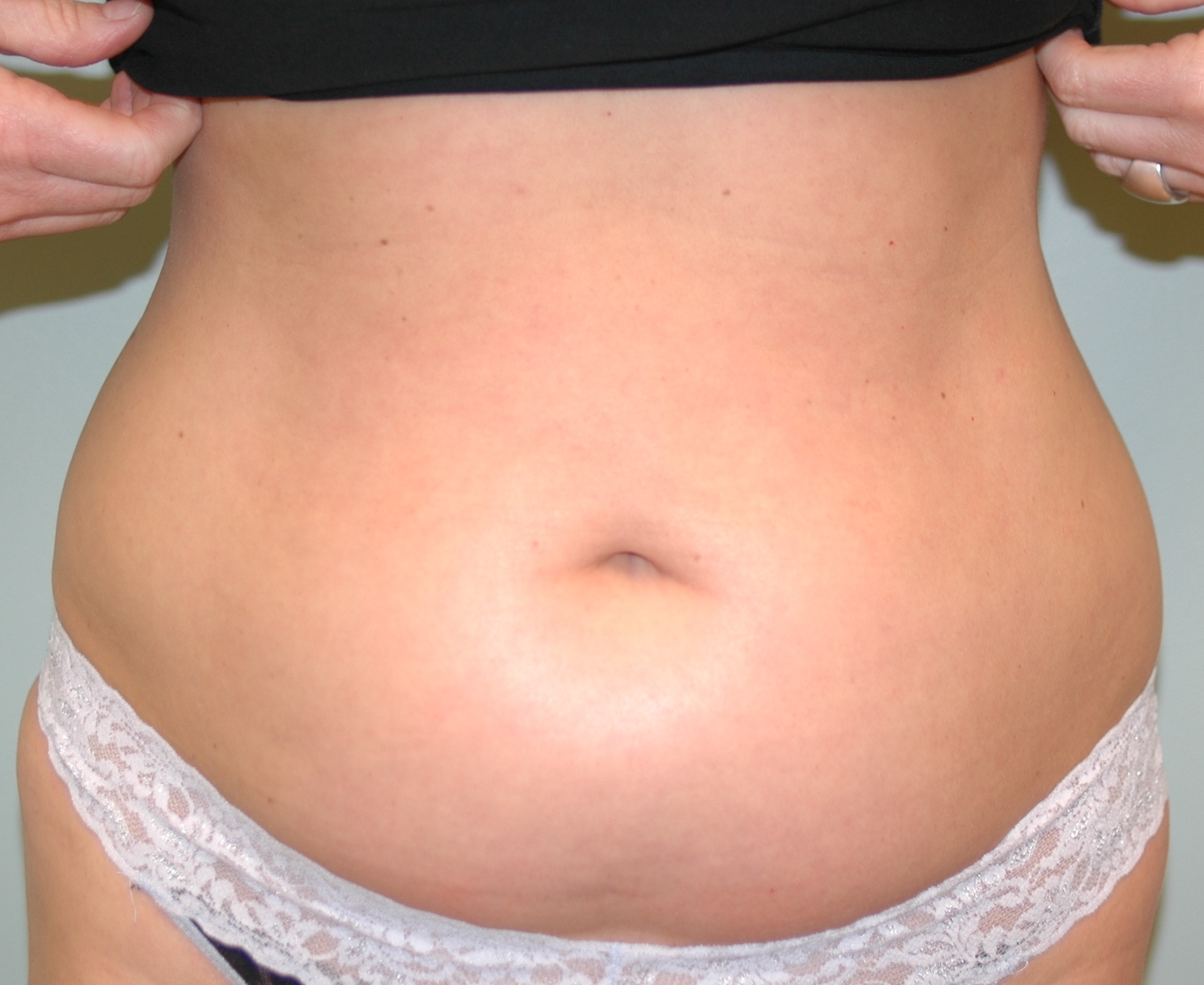 Case--9333 | Before Liposuction