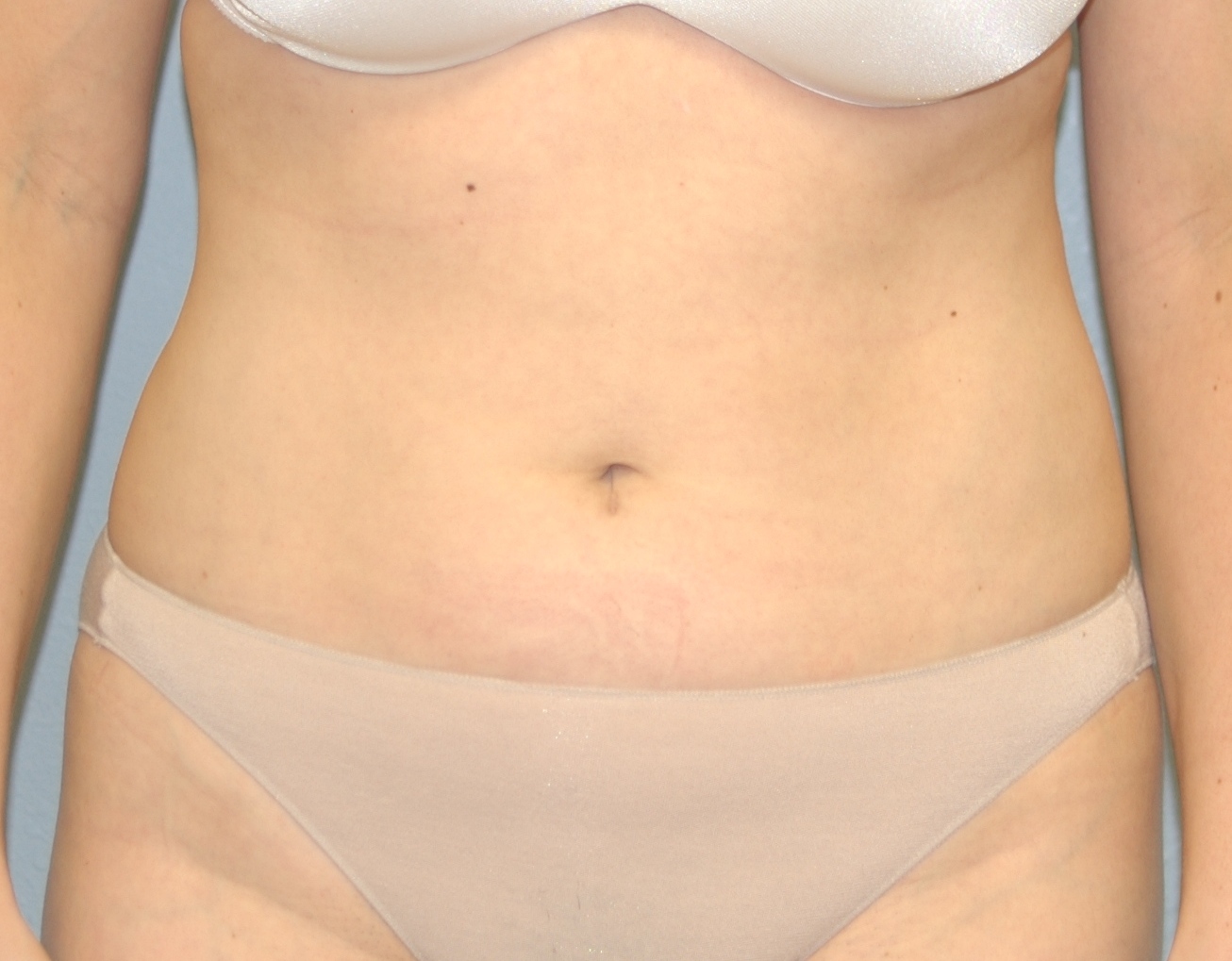 Case--9160 | After Liposuction