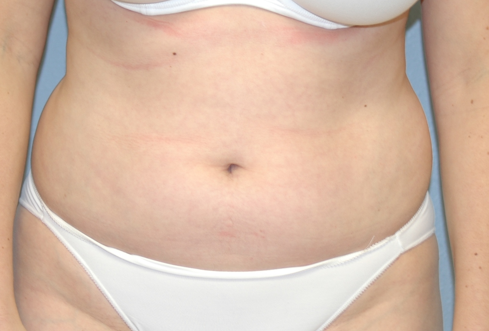 Case--9160 | Before Liposuction