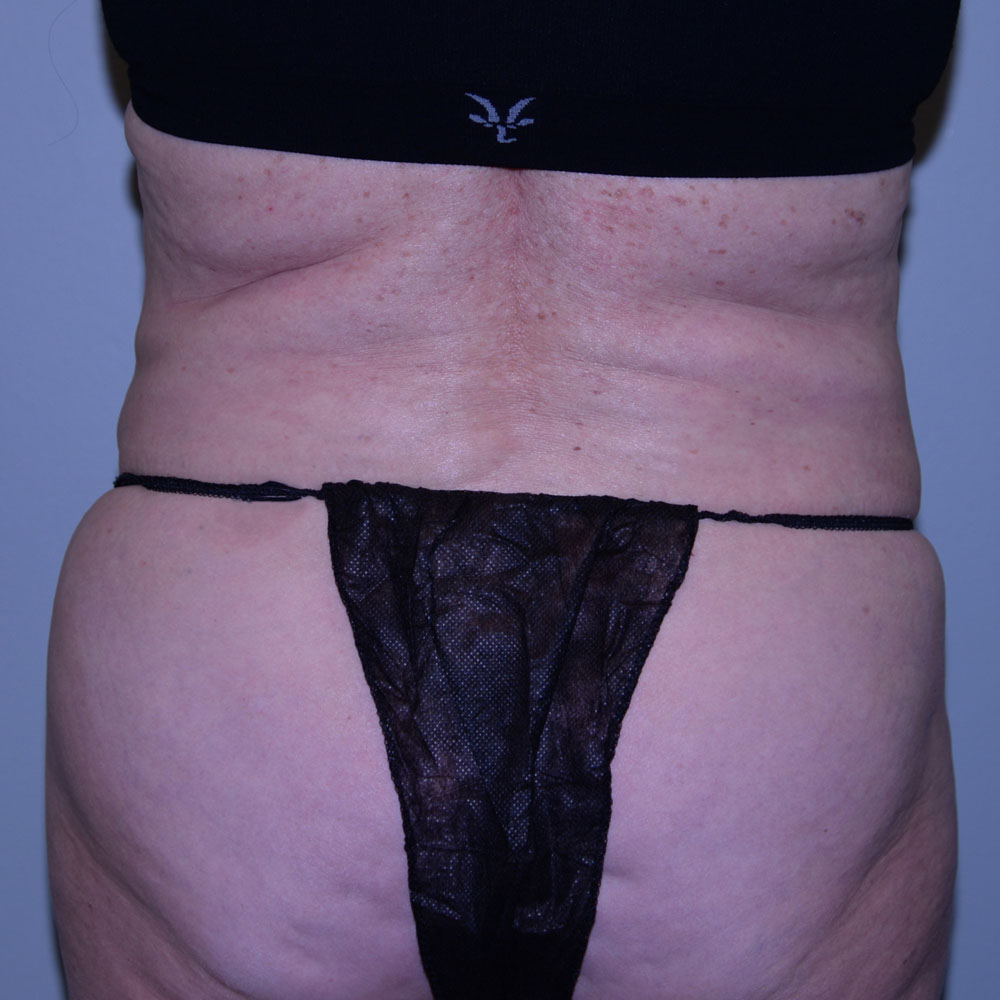 Case--2119 | Before CoolSculpting