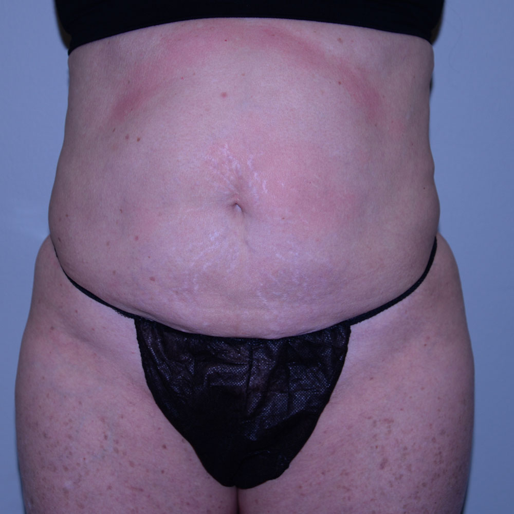 Case--2119 | Before CoolSculpting 2