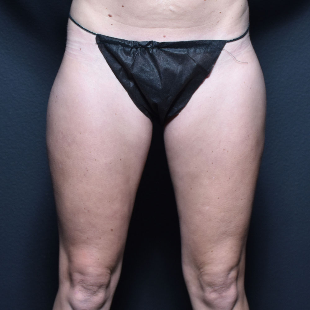 Case--2112 | After CoolSculpting 2