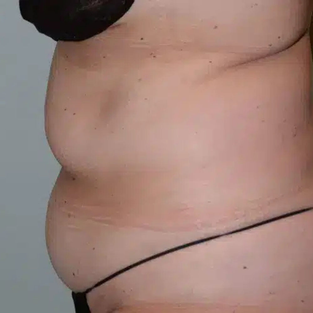 Case--2113 | Before CoolSculpting