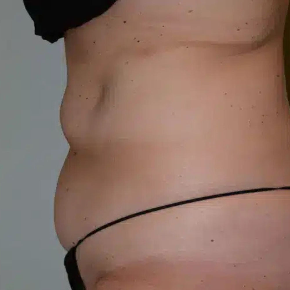 Case--2113 | After CoolSculpting