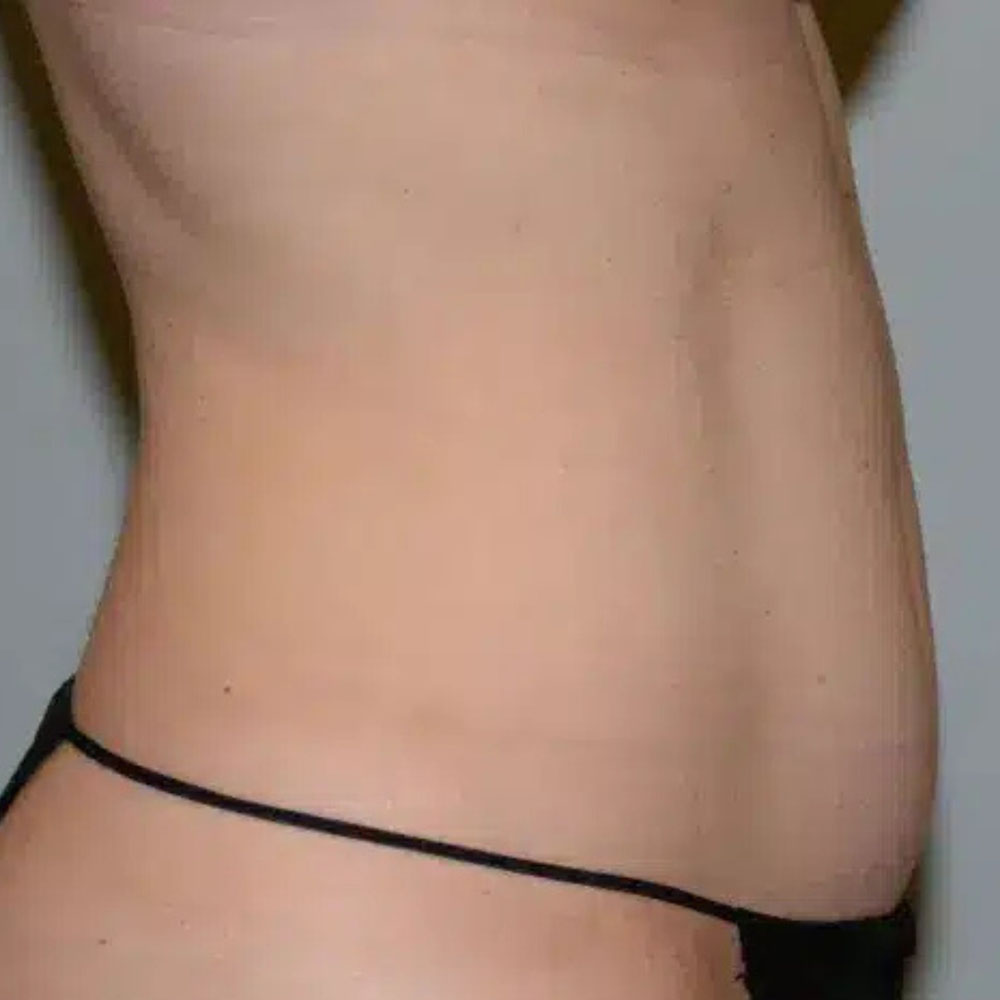 Case--2114 | Before CoolSculpting