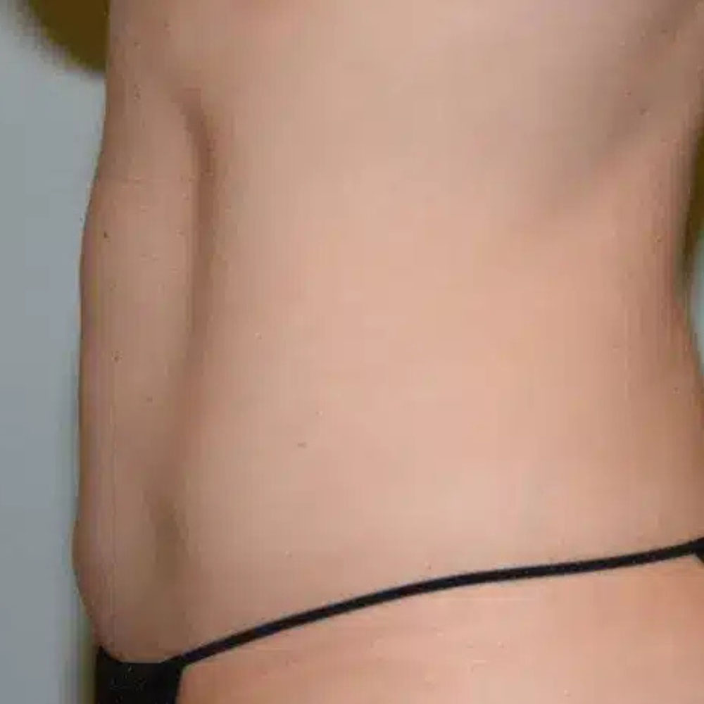 Case--2114 | After CoolSculpting 2