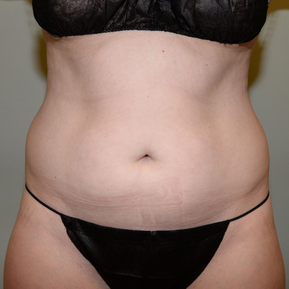 Case--2115 | Before CoolSculpting 2