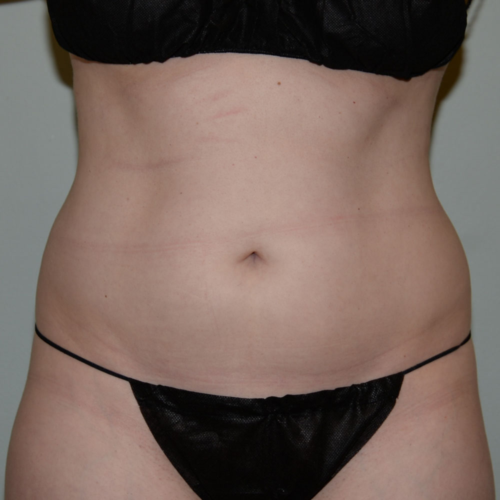 Case--2115 | After CoolSculpting 2