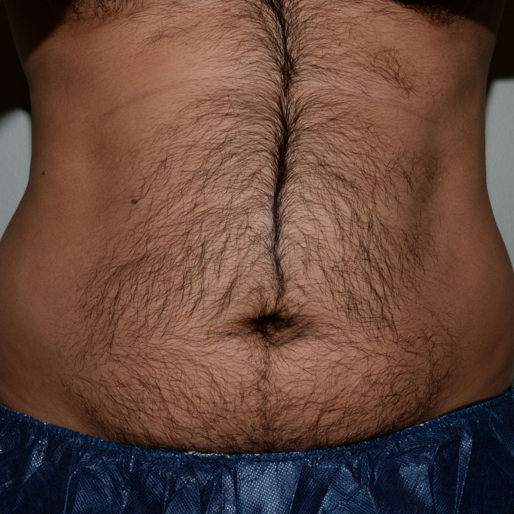 Case--2116 | Before CoolSculpting