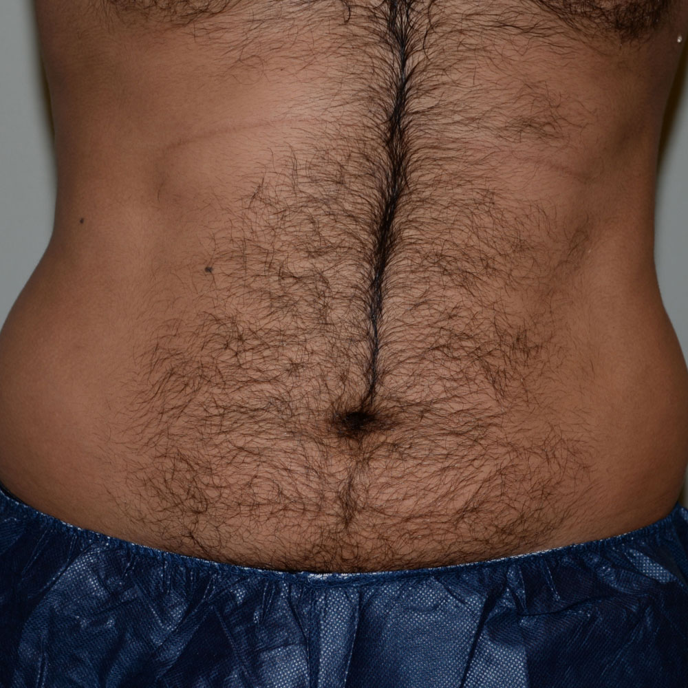 Case--2116 | After CoolSculpting