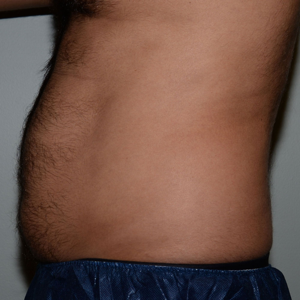 Case--2116 | Before CoolSculpting 2