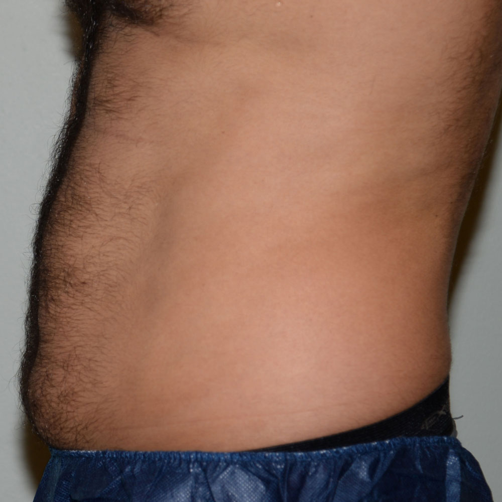 Case--2116 | After CoolSculpting 2