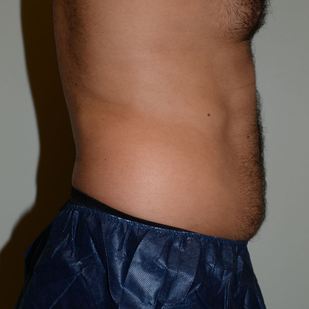 Case--2116 | After CoolSculpting 3