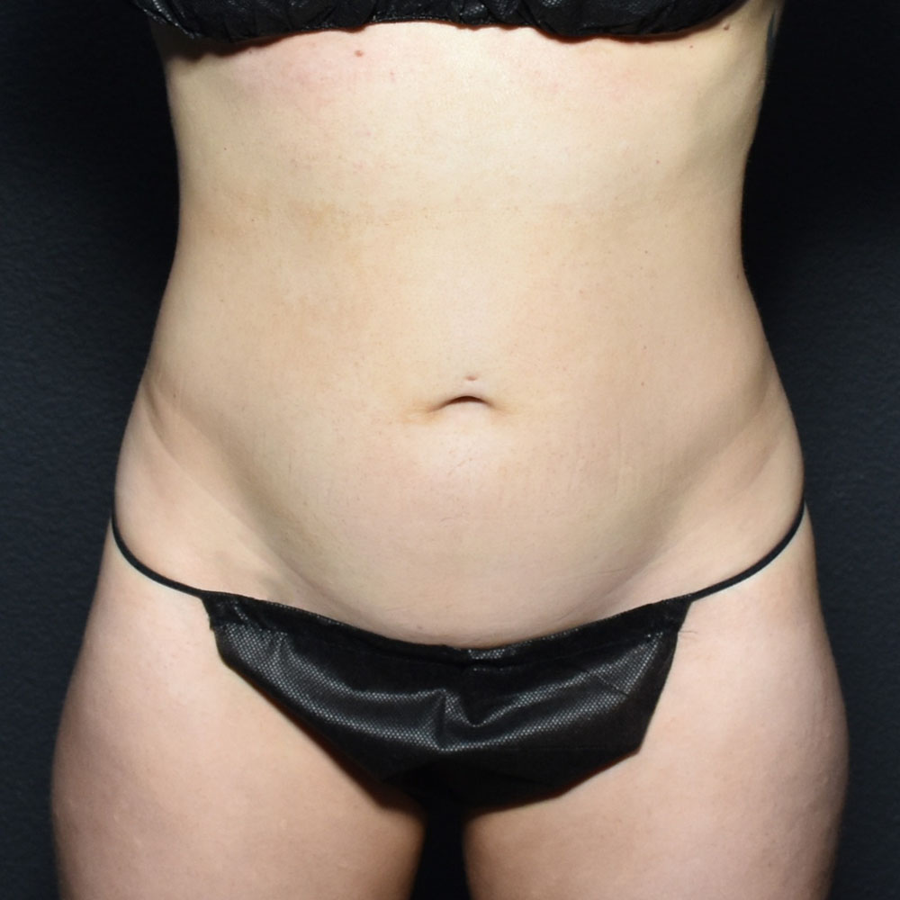 Case--2118 | Before CoolSculpting
