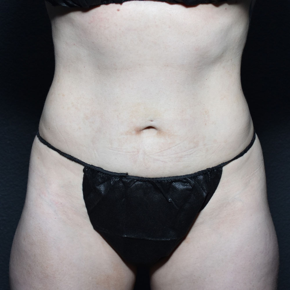 Case--2118 | After CoolSculpting