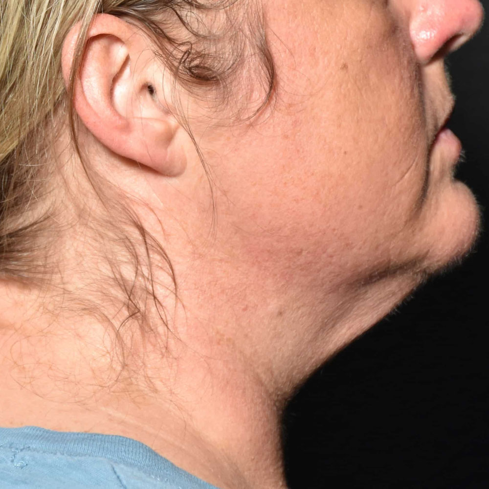 Case--2123 | After CoolSculpting