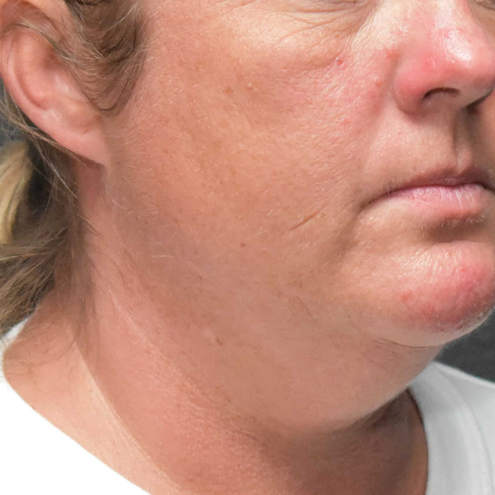 Case--2123 | Before CoolSculpting 2