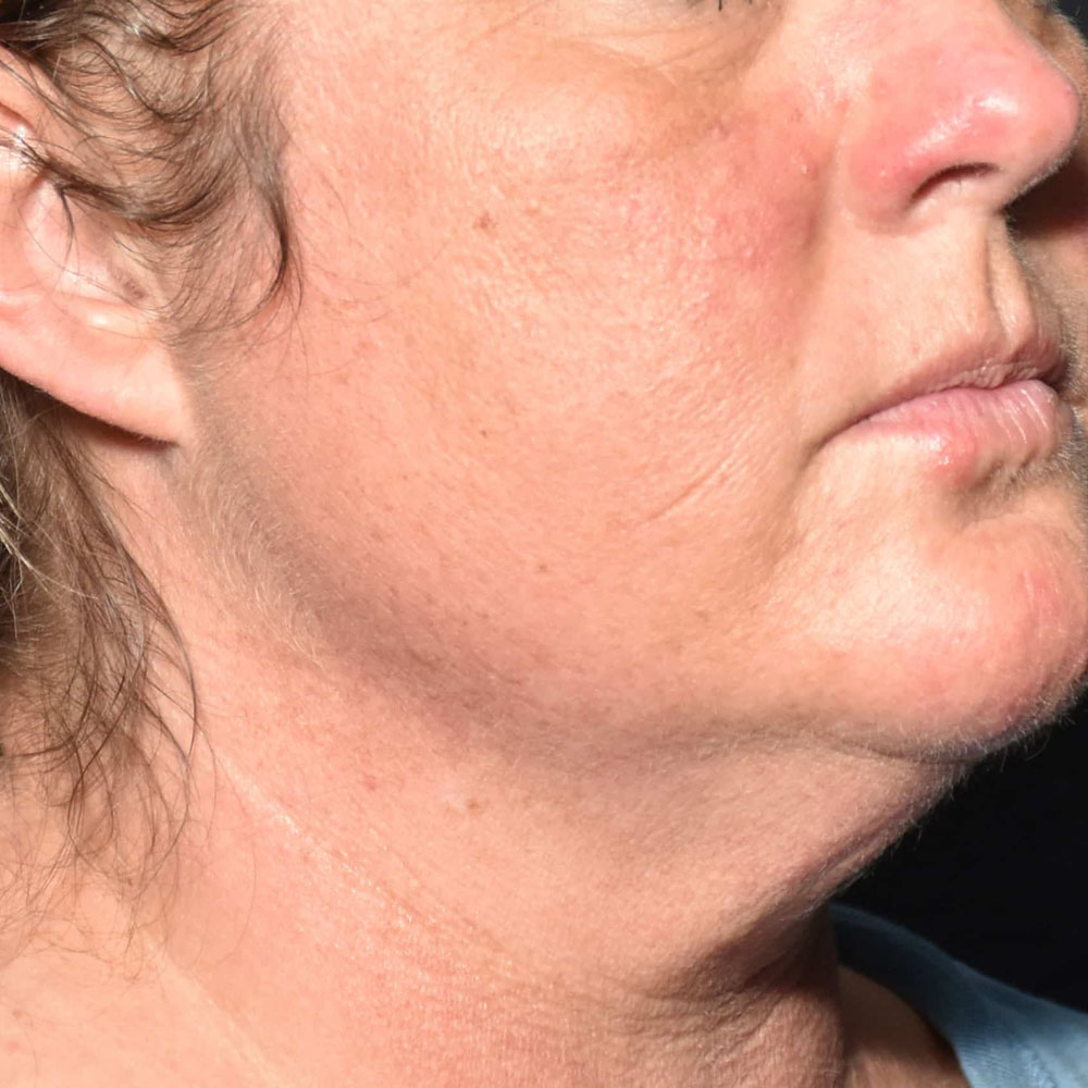 Case--2123 | After CoolSculpting 2