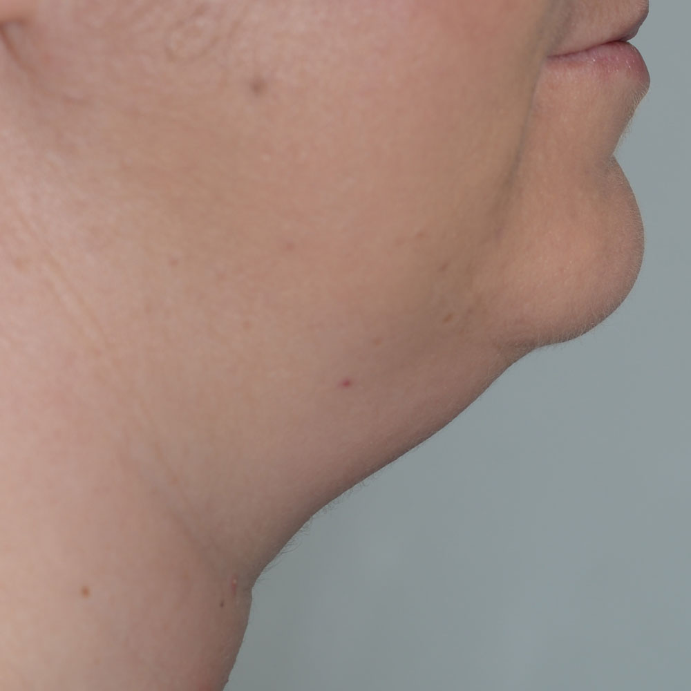 Case--2124 | Before CoolSculpting