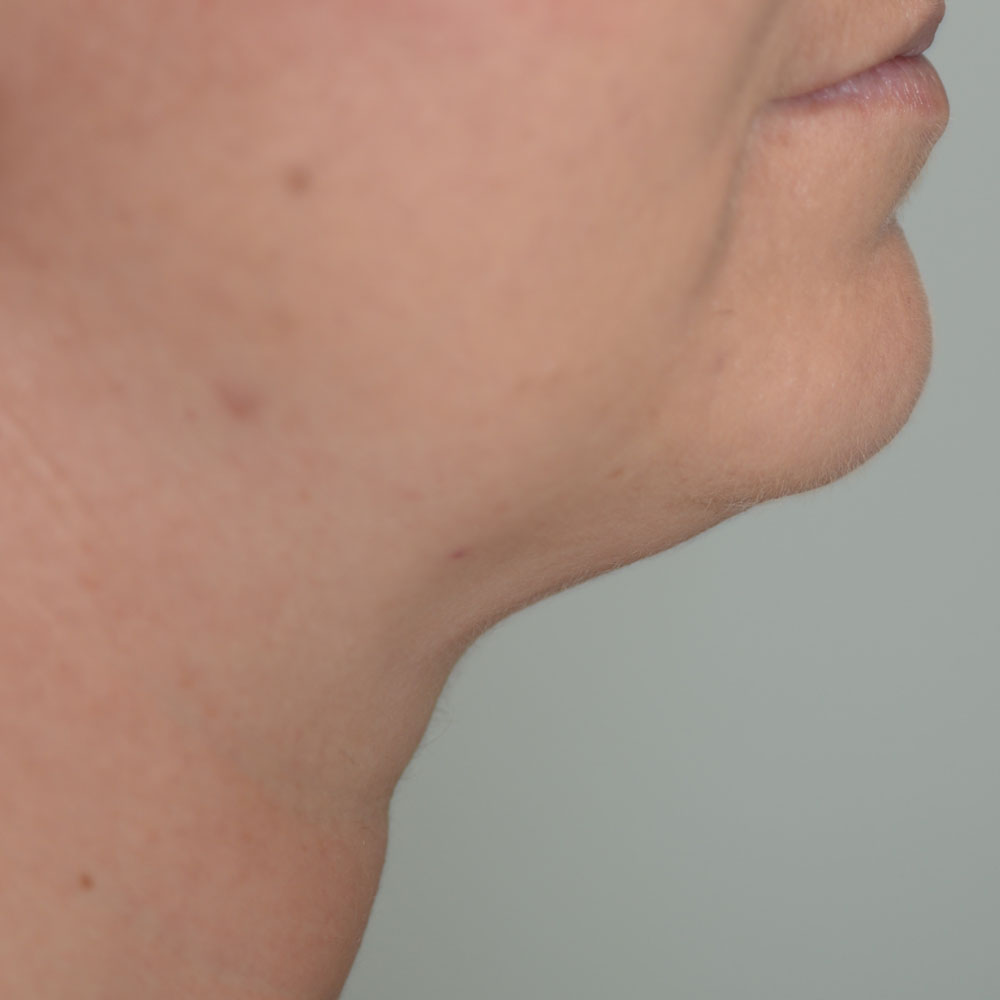 Case--2124 | After CoolSculpting