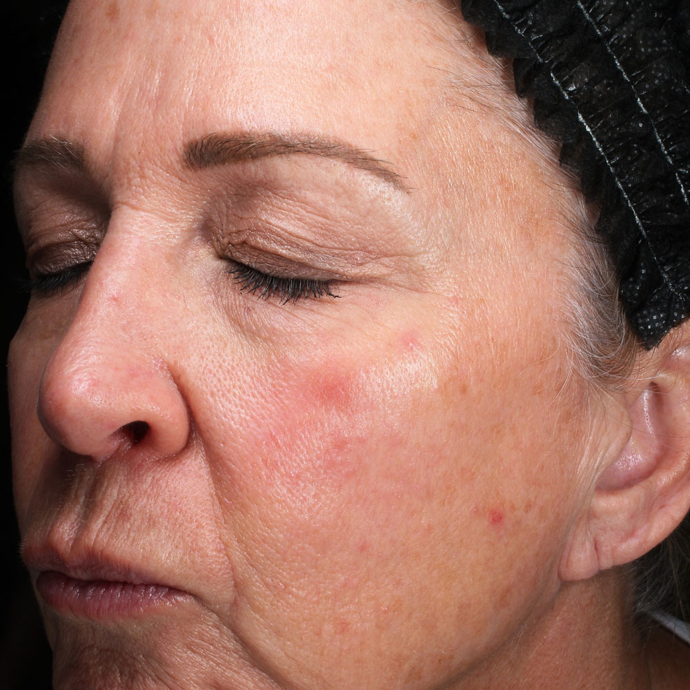 Case--2126 | Before Facials and Peels