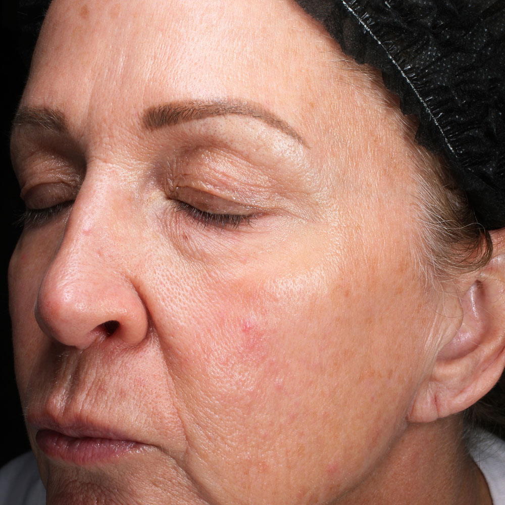 Case--2126 | After Facials and Peels