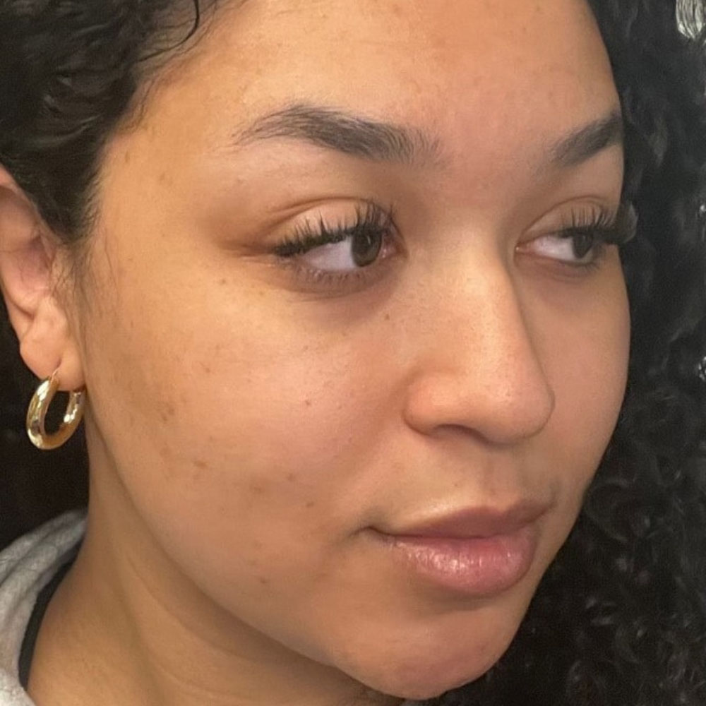 Case--2125 | Before Facials and Peels