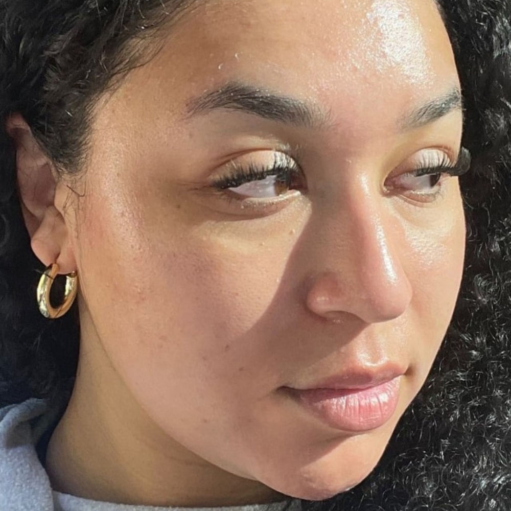 Case--2125 | After Facials and Peels