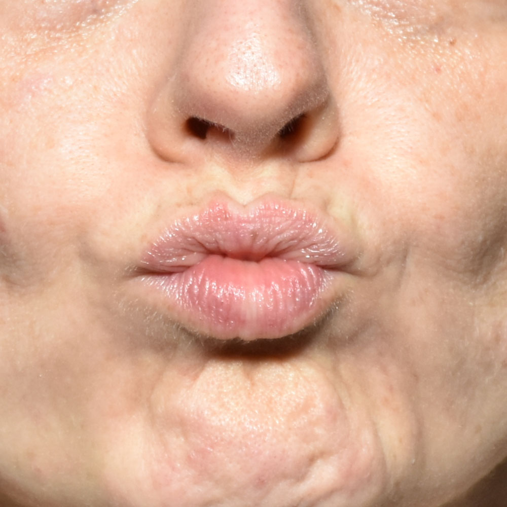 Case--2150 | Before Facial Fillers 2