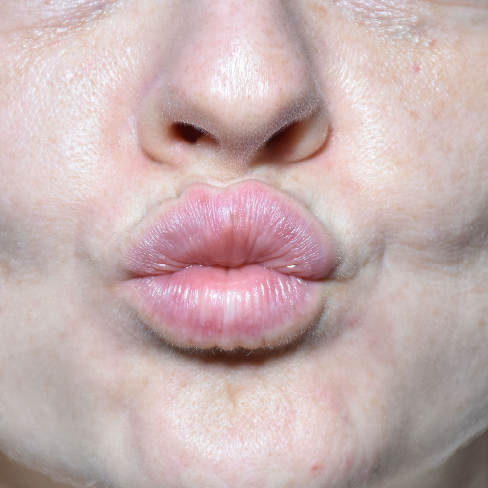 Case--2150 | After Facial Fillers 2