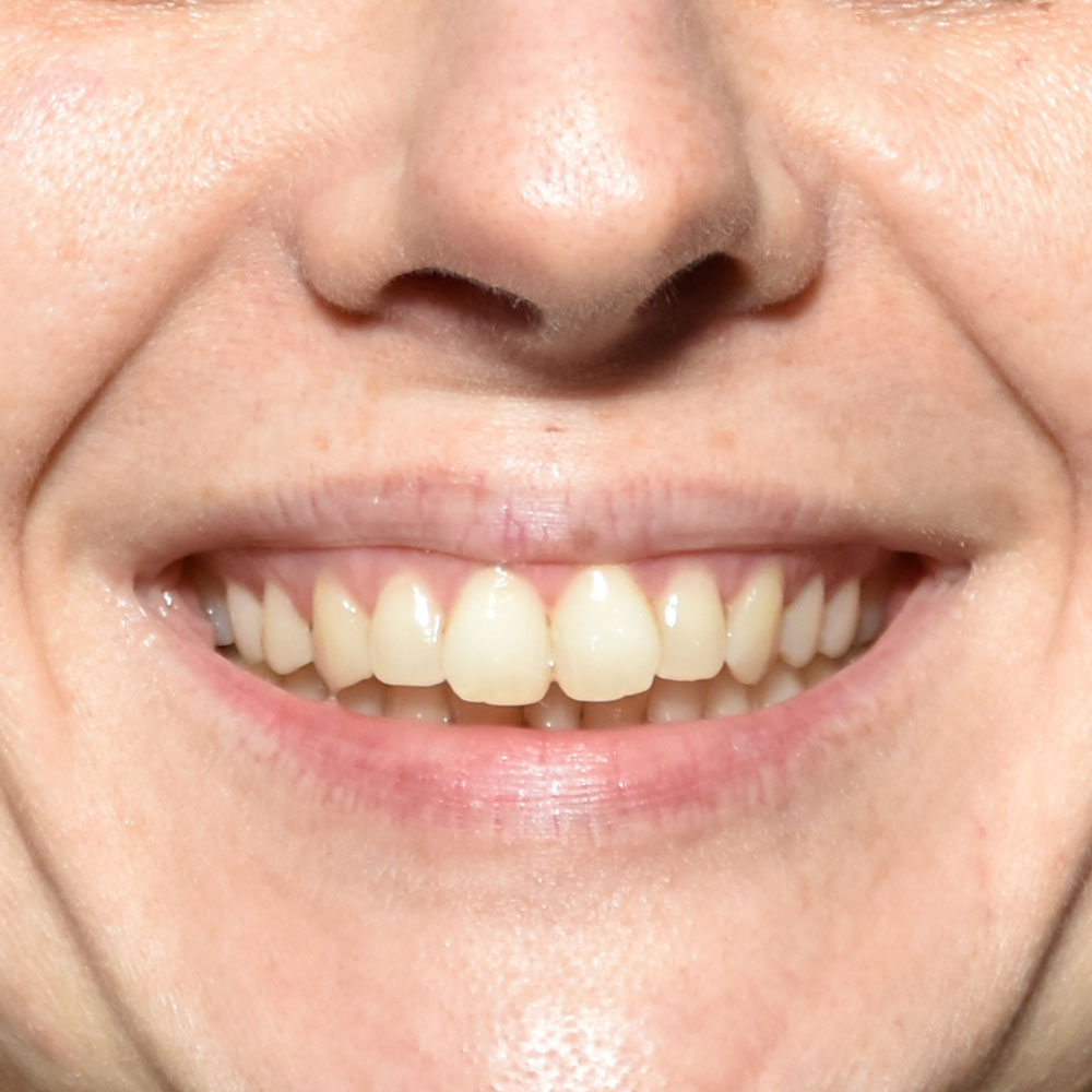 Case--2150 | Before Facial Fillers 3