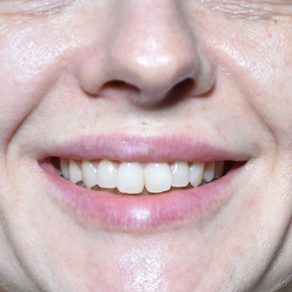 Case--2150 | After Facial Fillers 3