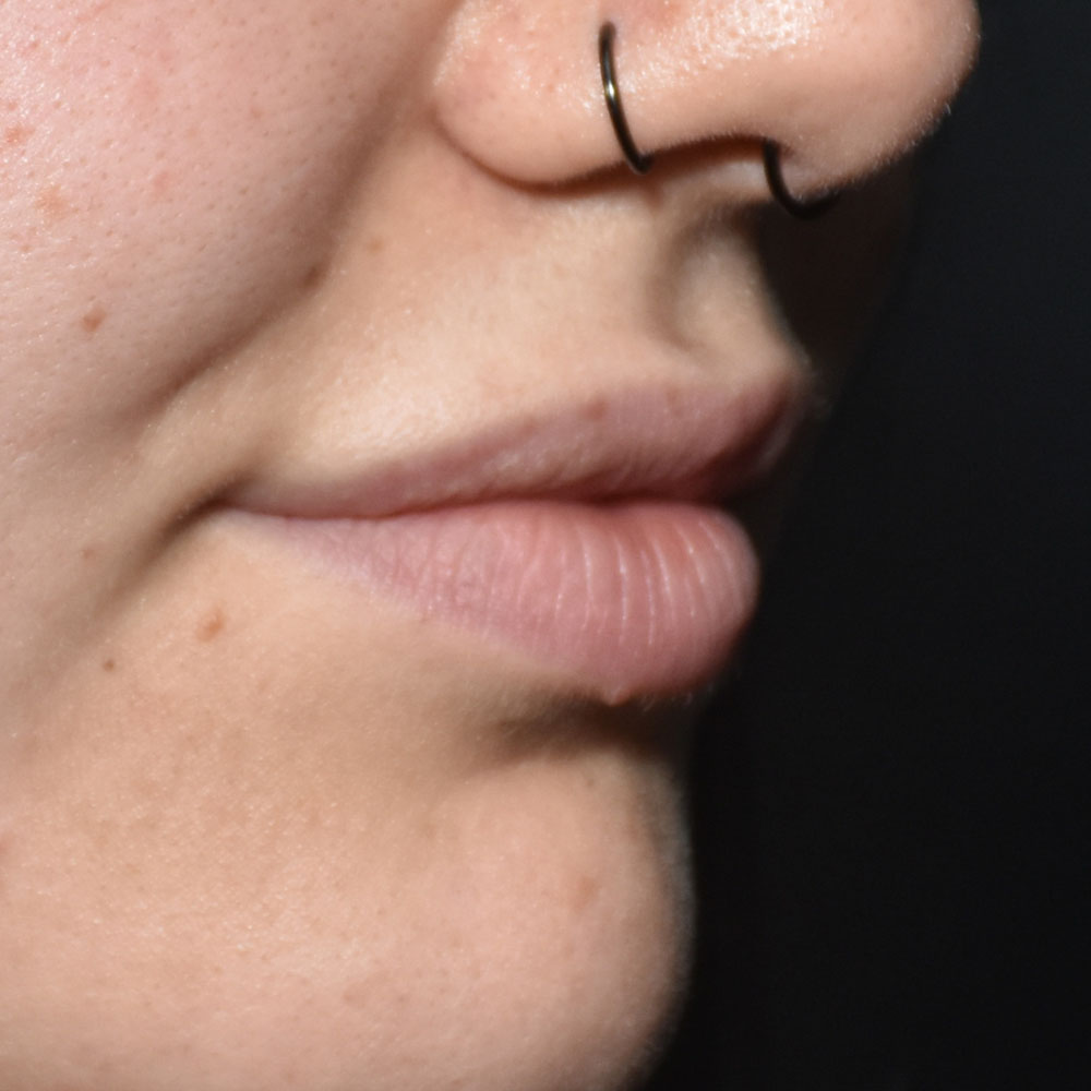 Case--2151 | After Facial Fillers