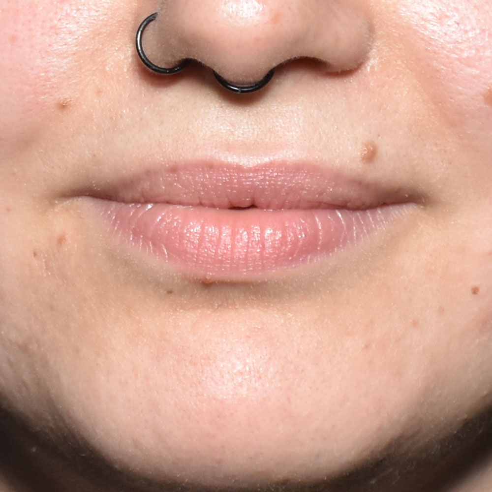 Case--2151 | Before Facial Fillers 2